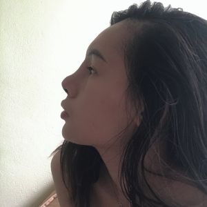 Sống mũi ở hốc mắt có gom thấp xuống không