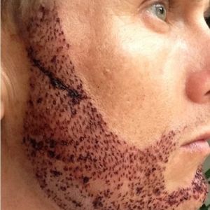 Hai ngày sau cấy râu, đã đến lúc vảy bong chưa?