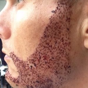 Hai ngày sau cấy râu, đã đến lúc vảy bong chưa?