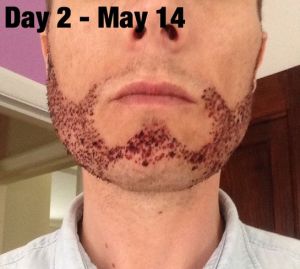 Hai ngày sau cấy râu, đã đến lúc vảy bong chưa?