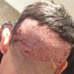 Hai ngày sau cấy râu, đã đến lúc vảy bong chưa?