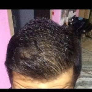 Sau cấy tóc 17 tháng: Tôi không biết phải làm gì, tôi cảm thấy kết quả không tốt