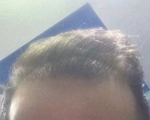 Sau cấy tóc 17 tháng: Tôi không biết phải làm gì, tôi cảm thấy kết quả không tốt