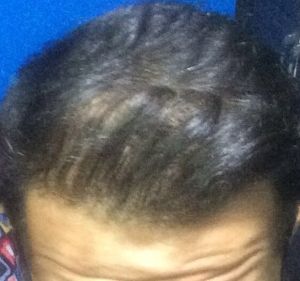 Sau cấy tóc 17 tháng: Tôi không biết phải làm gì, tôi cảm thấy kết quả không tốt