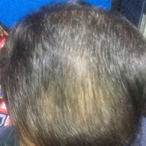 Sau cấy tóc 17 tháng: Tôi không biết phải làm gì, tôi cảm thấy kết quả không tốt