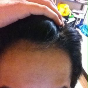 Cháu có thể cấy tóc khi mới 15 tuổi không?