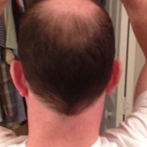 Năm nay tôi 45 tuổi, nam, liệu tôi có phải đối tượng thích hợp để làm cấy tóc không?