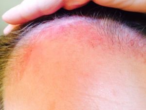 Da đầu bị đỏ sau cấy tóc hai tháng rưỡi?