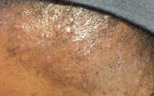 Sau cấy tóc 4 tuần, đầu bị đỏ, mọc mụn, lỗ chỗ, có bình thường hay không?