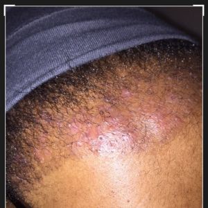 Sau cấy tóc 4 tuần, đầu bị đỏ, mọc mụn, lỗ chỗ, có bình thường hay không?