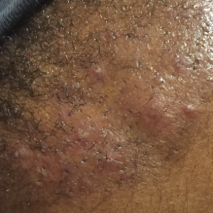 Sau cấy tóc 4 tuần, đầu bị đỏ, mọc mụn, lỗ chỗ, có bình thường hay không?