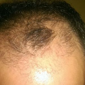 Có thể dùng Procapil lâu dài sau cấy tóc để đạt hiệu quả cao không?