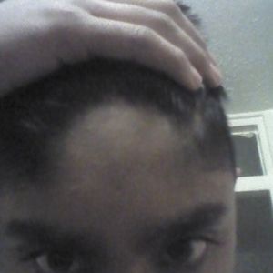 Cháu nên làm gì để chữa đường chân tóc, dùng laser triệt tóc hay cấy tóc?