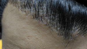 Tóc mọc như thế này sau 10 tháng kể từ khi cấy tóc có bình thường không?