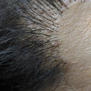 Tóc mọc như thế này sau 10 tháng kể từ khi cấy tóc có bình thường không?