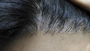 Tóc mọc như thế này sau 10 tháng kể từ khi cấy tóc có bình thường không?