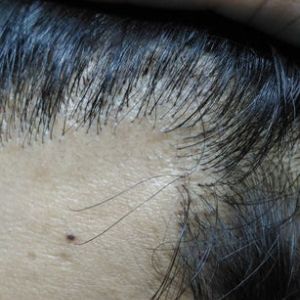 Tóc mọc như thế này sau 10 tháng kể từ khi cấy tóc có bình thường không?