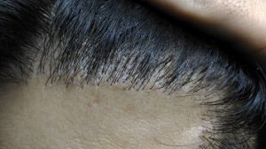 Tóc mọc như thế này sau 10 tháng kể từ khi cấy tóc có bình thường không?