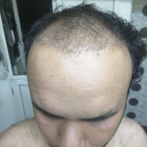 Sáu tháng sau khi cấy tóc, tôi không hài lòng với độ dày và mật độ tóc, ban ngày nhìn rõ tóc bị thưa