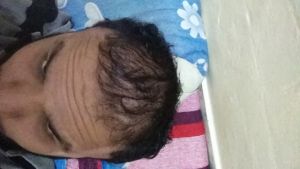 Sáu tháng sau khi cấy tóc, tôi không hài lòng với độ dày và mật độ tóc, ban ngày nhìn rõ tóc bị thưa