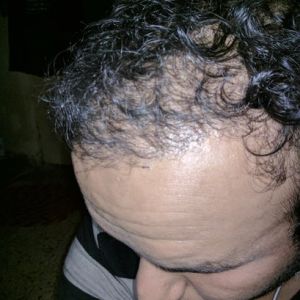 Sáu tháng sau khi cấy tóc, tôi không hài lòng với độ dày và mật độ tóc, ban ngày nhìn rõ tóc bị thưa