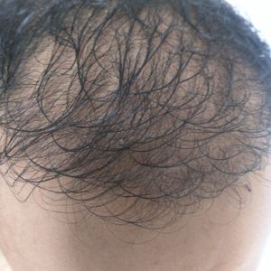 Sáu tháng sau khi cấy tóc, tôi không hài lòng với độ dày và mật độ tóc, ban ngày nhìn rõ tóc bị thưa