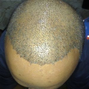 Sáu tháng sau khi cấy tóc, tôi không hài lòng với độ dày và mật độ tóc, ban ngày nhìn rõ tóc bị thưa