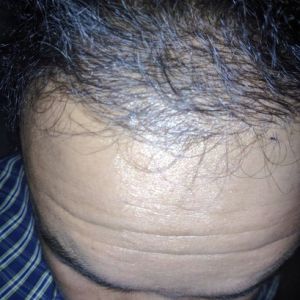 Sáu tháng sau khi cấy tóc, tôi không hài lòng với độ dày và mật độ tóc, ban ngày nhìn rõ tóc bị thưa