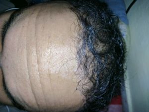 Sáu tháng sau khi cấy tóc, tôi không hài lòng với độ dày và mật độ tóc, ban ngày nhìn rõ tóc bị thưa