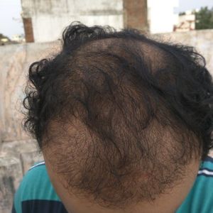 Sáu tháng sau khi cấy tóc, tôi không hài lòng với độ dày và mật độ tóc, ban ngày nhìn rõ tóc bị thưa