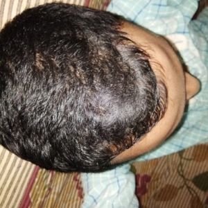 Tôi có thể cấy tóc xuyên qua hoặc giữa các nang tóc hiện tại không?