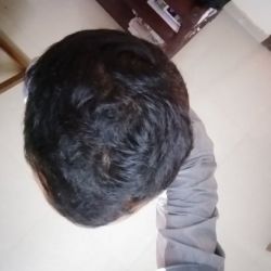 Tôi có thể cấy tóc xuyên qua hoặc giữa các nang tóc hiện tại không?