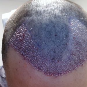 Cấy tóc với mật độ 33 cụm nang tóc/cm2, tóc tôi sau 12 tháng sẽ thưa đến mức nào?