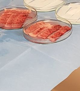 Cấy tóc với mật độ 33 cụm nang tóc/cm2, tóc tôi sau 12 tháng sẽ thưa đến mức nào?