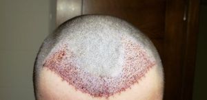 Cấy tóc với mật độ 33 cụm nang tóc/cm2, tóc tôi sau 12 tháng sẽ thưa đến mức nào?