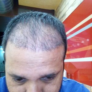 Không hài lòng với tình trạng tóc mọc sau ba tháng, cần lời khuyên?