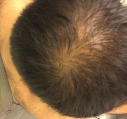 Rụng tóc hói do gen di truyền ở đỉnh đầu, tôi nên cấy tóc hay dùng minoxidil?