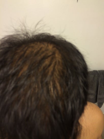 Rụng tóc hói do gen di truyền ở đỉnh đầu tôi nên cấy tóc hay dùng  minoxidil