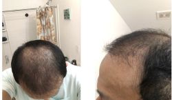 Đã cấy tóc được 6 tháng, kết quả như thế này có bình thường không?