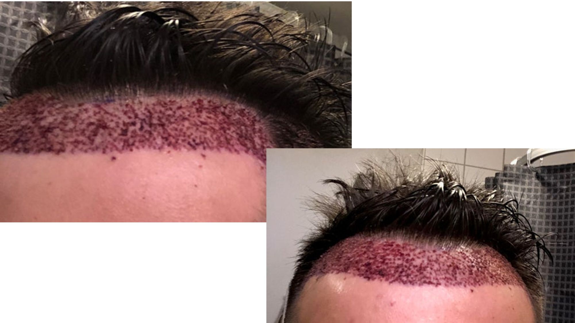 Tôi vừa phẫu thuật 6 ngày trước, mật độ tóc như thế này có ổn không, hay là 12 tháng nữa tôi lại phải cấy thêm tóc?