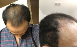 Đã cấy tóc được 6 tháng, kết quả như thế này có bình thường không?