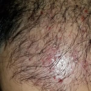 Tôi có nên lo lắng khi bị mọc mụn sau cấy tóc ba tháng?