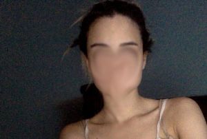 Cháu nên làm phẫu thuật gì để hạ đường chân tóc?