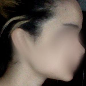 Cháu nên làm phẫu thuật gì để hạ đường chân tóc?