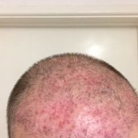 Ba tháng sau cấy tóc, dùng kháng sinh và kem steroid, có u cục và các mảng hói, tóc tôi có mọc lại hay không?