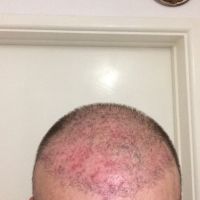 Ba tháng sau cấy tóc, dùng kháng sinh và kem steroid, có u cục và các mảng hói, tóc tôi có mọc lại hay không?