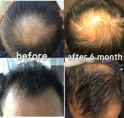 Đã 6 tháng kể từ khi làm cấy tóc, tôi vẫn tiếp tục bị sốc rụng tóc sao?