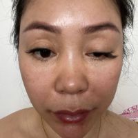 Liệu mí mắt có bị sụp vĩnh viễn sau khi tiêm botox? Liệu mí mắt có bị sụp vĩnh viễn sau khi tiêm botox?