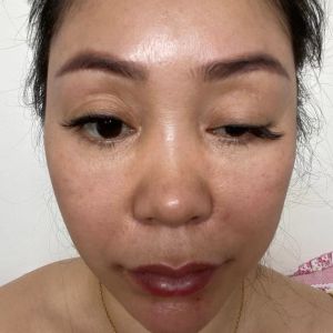 Liệu mí mắt có bị sụp vĩnh viễn sau khi tiêm botox?