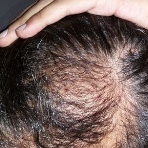 Xin hãy đánh giá kết quả cấy tóc của tôi, tôi cấy tóc từ 6 tháng trước